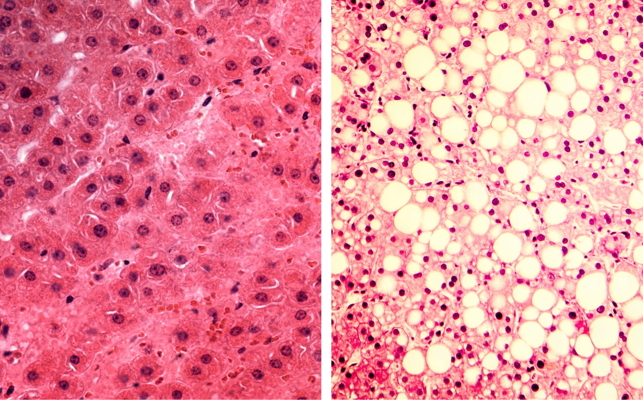 Comparación histológica: hepatocitos sanos vs. hepatocitos con grasa